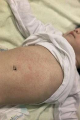 Roseola -HHV 6 -High persistent fever for approx 72 hours -Anorexia and irritability -Erythematous maculopapular exanthem occurring simultaneously with defervescence Vincent Hu, https://flic.
