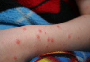 Measles -Prodrome of fever, malaise, cough (dry), coryza (runny nose), and conjunctivitis (clear d/c with photophobia), pt s often ill and lethargic appearing -Koplik s spots are