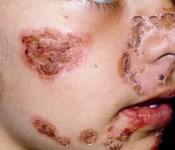 -vesicular lesions which often evolve to