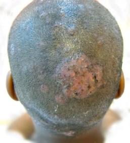 areas Tinea Capitis -can present in various ways as patches of alopecia