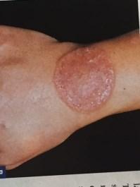 -annular lesions, often well circumscribed with central clearing with an active