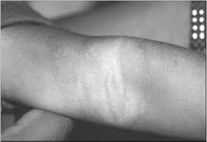 Red, itchy, flaky dry patches Papules may be present Usually starts in skin