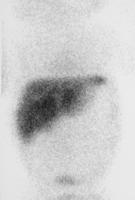Positive study in biliary atresia 24 hour image Note good uptake No