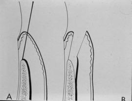Periodontal Flap: Full thickness flap -