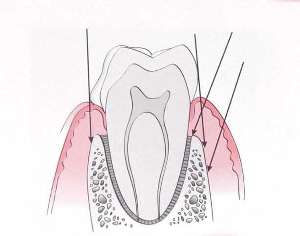Incision: Intrasulcular - full retention of the tissues Inverse bevel - splits the soft