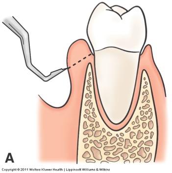 Gingivectomy the surgical removal of the gingival