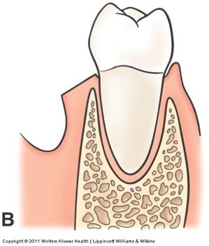 Results in more apical position of the gingival margin.