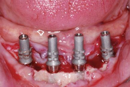 Dental Implant artificial tooth root placed into the