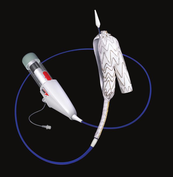 GORE EXCLUDER AAA Endoprosthesis The most-studied* EVAR stent graft designed for durable outcomes.