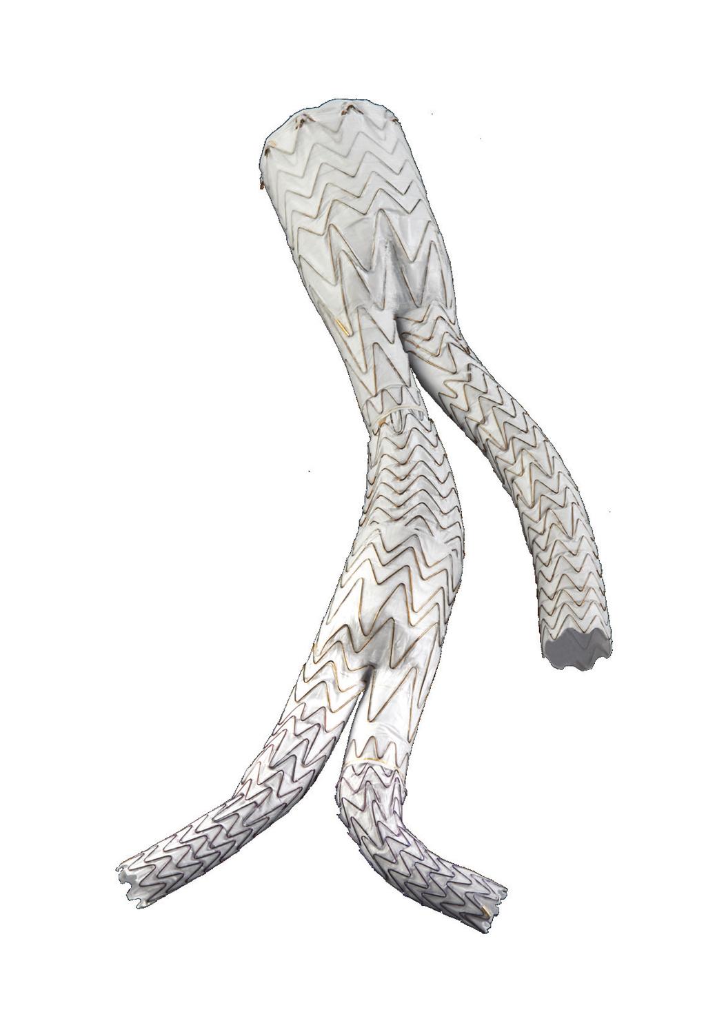 GORE EXCLUDER Iliac Branch Endoprosthesis U.S. IDE Clinical Trial now has 2-year follow-up data for all patients from primary enrollment (n = 63).