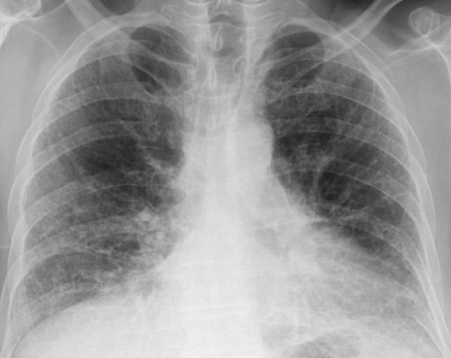 Chest radiograph in IPF