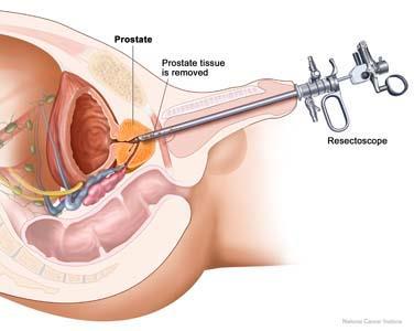 What does TURP Involve? This operation can be carried out under general or spinal anaesthetic. An instrument is passed up the urethra and into the prostate gland.