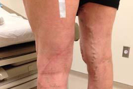 A 62-year-old man with varicose veins and leg pain On physical examination, the