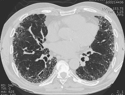 The diagnosis of IPF requires: a)exclusion of other known causes of interstitial lung disease b)the presence of a UIP pattern on HRCT in patients not subjected to surgical lung biopsy c)specific