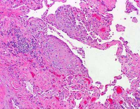 Specimens: Histopathology of UIP Pattern Preserved lung