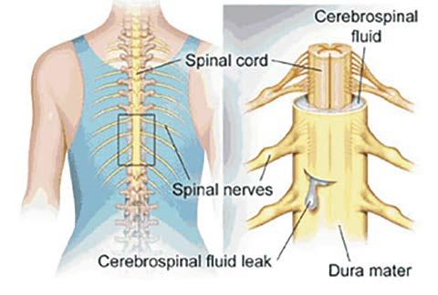 NERVE OR SPINAL CORD INJURY When surgery is carried out on the spine there is some risk of injuring the spinal cord or the individual nerves.