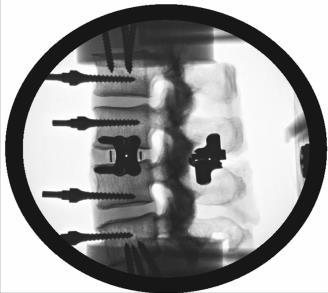 Range of Motion METHODS: Specimen - Human Cadaveric Lumbar Spines (L1-L4; n = 7) Posterior Fixation at L2-L3 - Bilateral pedicle screw fixation (BPSF) - Alpine XC