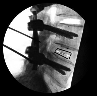 Cage Load & Lordosis Angle Pedicle Screws ISPF RESULTS: Alpine XC achieves 5 increase in