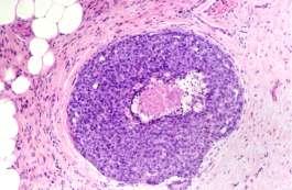 Confirmatory Studies Pathologic finding Proliferative disease without atypia Nashville Cohort (1985) Nurse s Health Study (1992) Breast