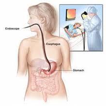 Endoscopy Nausea, Vomiting and Diarrhea cha cha
