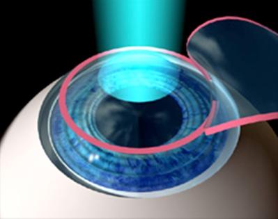 Corneal Refractive Surgery (CRS) LASIK Corneal flap created using microkeratome Underlying corneal stroma reshaped by excimer laser Corneal flap replaced over stroma, no sutures required