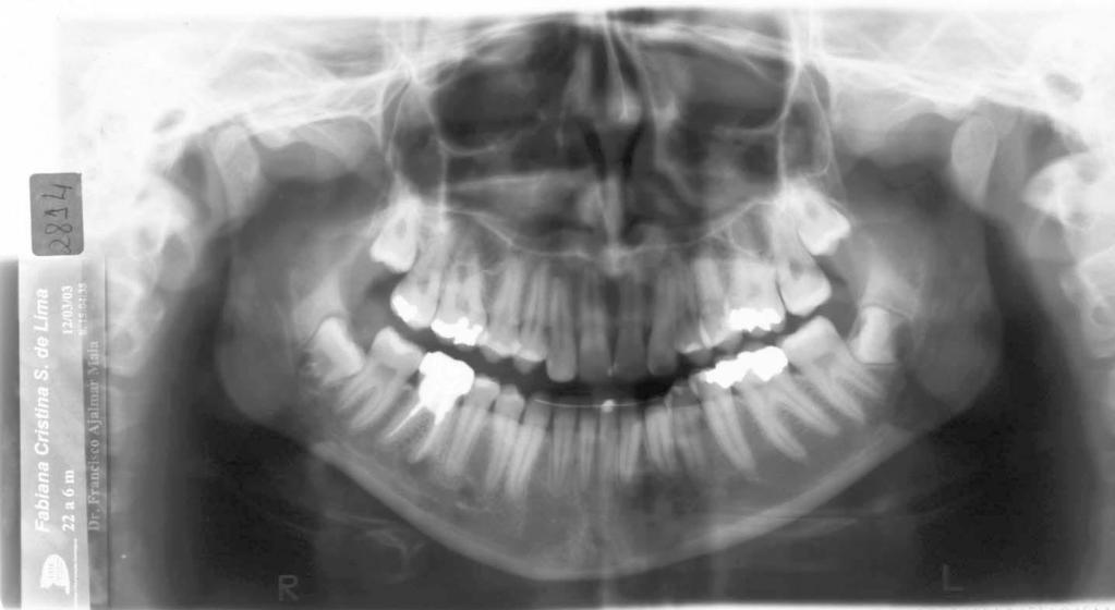 TRANSPOSITION OF TEETH 275 FIGURE 13. Panoramic radiography seven years and seven months after treatment.