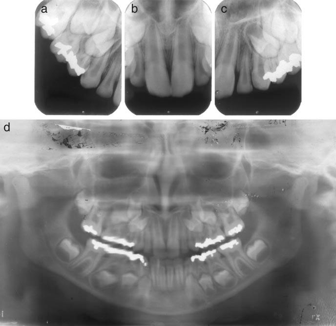 (d) The upper arch occlusal view shows the primary lateral incisor retention. (e) The lower arch occlusal view shows anterior primary crowding.