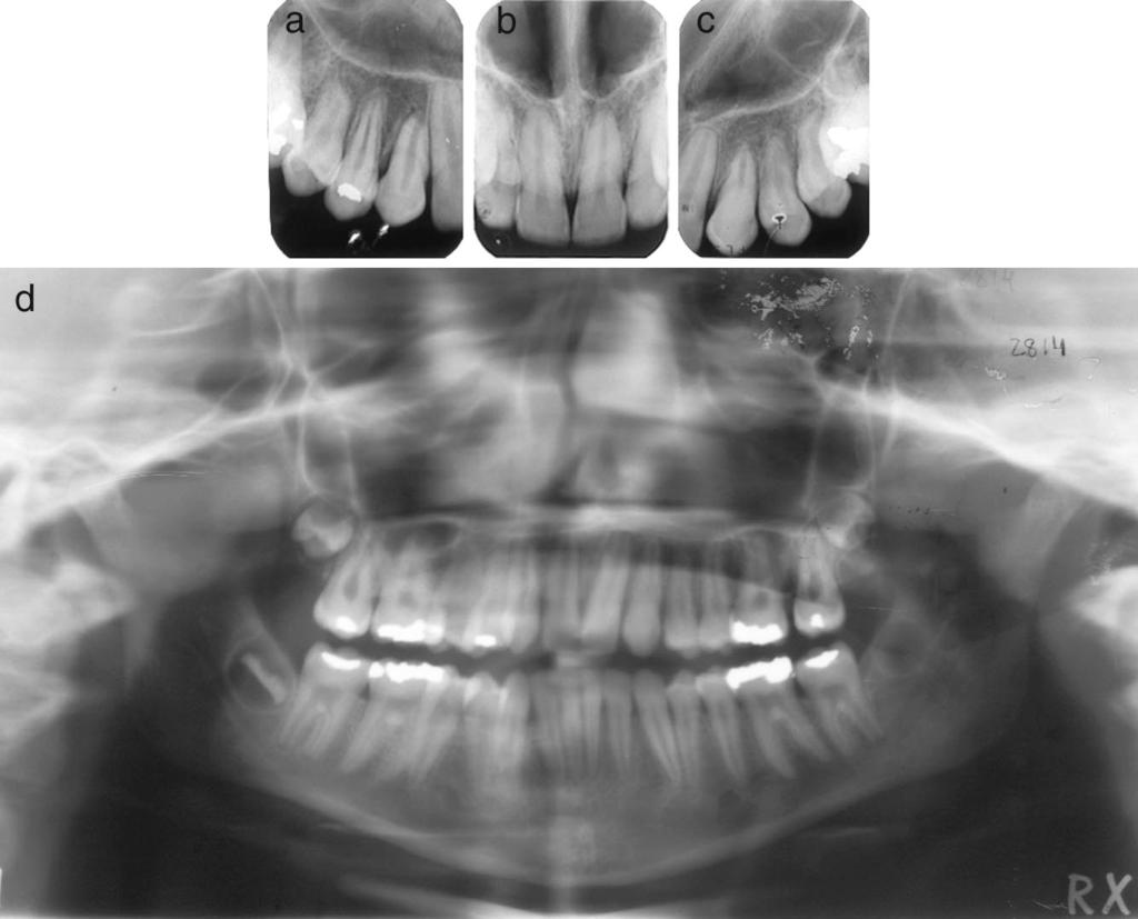 position. (d) Upper arch occlusal view showing the arch shape. (e) Lower arch occlusal view showing the good alignment and arch form.