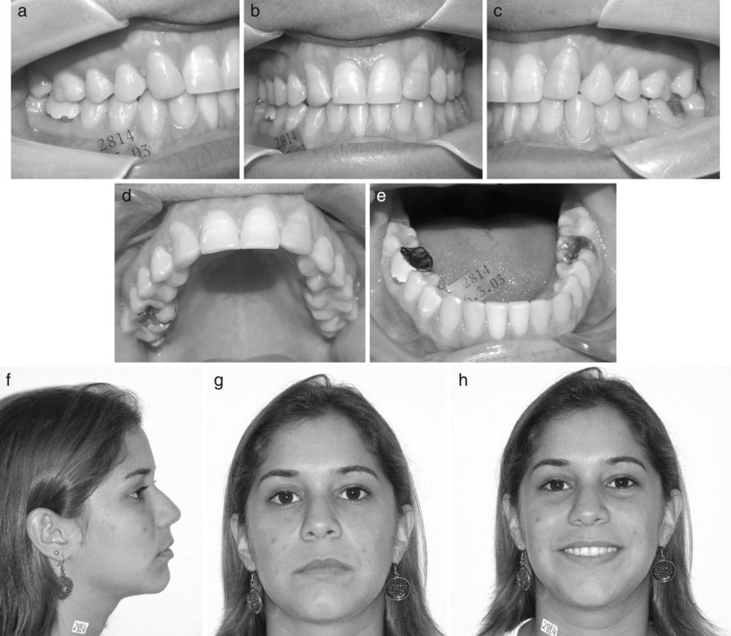 TRANSPOSITION OF TEETH 273 FIGURE 11. Intraoral photographs (a, b, c) of patient seven years and seven months after treatment showing transposition correction and intercuspation stability.