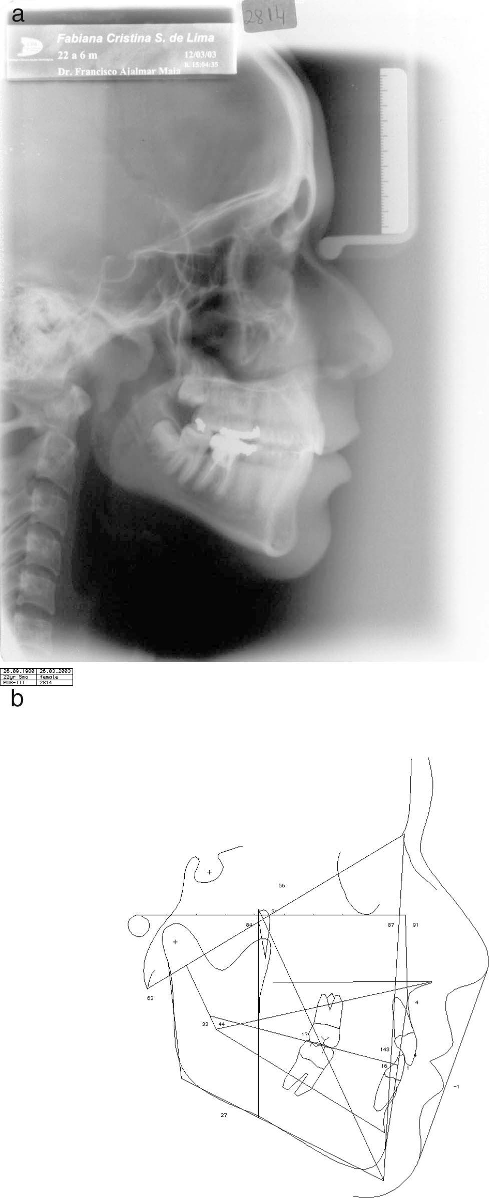274 AJALMAR MAIA, GALVÃO MAIA FIGURE 12. Cephalometric radiography (a) tracing and measurements (b) seven years and seven months after treatment. dontic space closure.