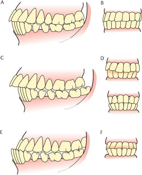 DENTITION Types of occlusion: A+B : Class I Normal occlusion (upper teeth slightly in front of lower teeth) C+D: Class II Malocclusion (upper teeth too far in