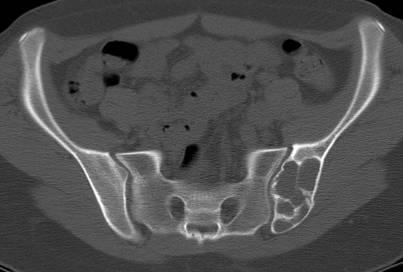 Bone Cyst CT Aneurysmal