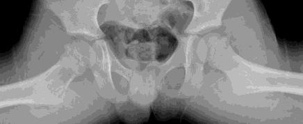 B) Unicameral (Simple) Bone Cyst p 17 of