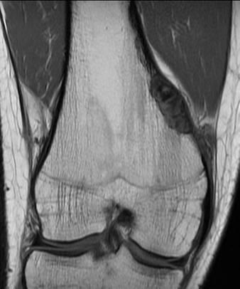 Femur & Tibia p 18 of 31 D) Fibrous Cortical Defect Non-Ossifying