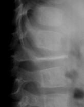 E) Eosinophilic Granuloma Pt Age: < 12 Matrix: None Location: Bone Marrow Skull (most common site) Spine vertebra plana Can regrow height with treatment!