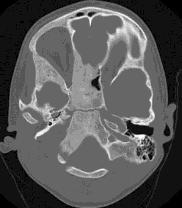 skull p 20 of 31 McCune Albright syndrome