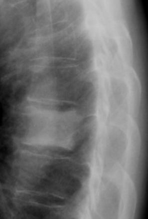 Ivory Vertebra Pt Met Breast Prostate Treated Met Chronic Osteo (Sarcoid) rare K,K 76yoM Ken L