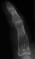 Often discovered incidentally Typically asymptomatic can be painful (40%) Pathologic Fracture 50% long tubular bones Metaphyseal Chondroid matrix