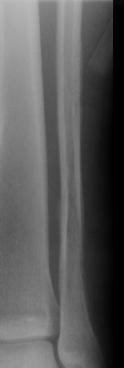 Non-aggressive   Radiographs Cortical Destruction MRI Soft Tissue Extension 2 Cases: