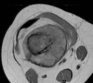 mets MR entire length of bone Osteogenic Sarcoma Pt Age: 10-20 years Location: Metaphyseal Matrix: Osseous F,C 8yoF MRI is useful for staging the extent of the