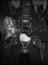 3 months later common in pelvis T2fs Things can hide in the pelvis S,B 6yoM Unlike in the
