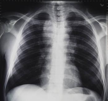 Case 3 Case 3 37 year old HIV (+) man, known contact to an active TB case, positive IGRA, no symptoms, with shown x-ray. The next step would be: A.