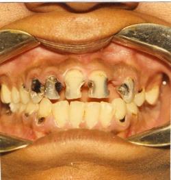 Dental Decay Factors that Increase Dental Decay