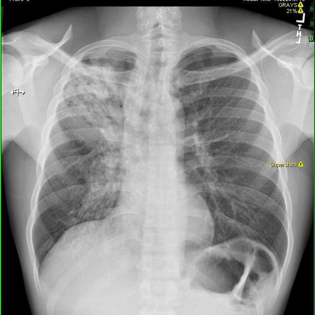 Tuberculosis Screening Flowchart At-risk person Tuberculin test/igra + symptom review Negative Positive Chest x-ray