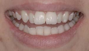 1 The first article (published in dentistry 2/10) demonstrated that standalone treatments offer patients an alternative to fixed braces, which are unsightly and have long treatment times, and to