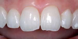 This article will demonstrate that patients who desire a more traditional smile makeover can achieve beautiful results in a more progressive manner that allows them to make their choices along the