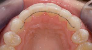 Despite this, veneers are often used to treat alignment issues and it is very difficult for patients to appreciate the alignment of their own teeth with wax-up or imaging.
