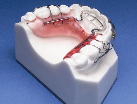 S. JY OWMN, DMD, MSD The Inman ligner,* a versatile removable appliance, is a unique modification of the traditional spring retainer.
