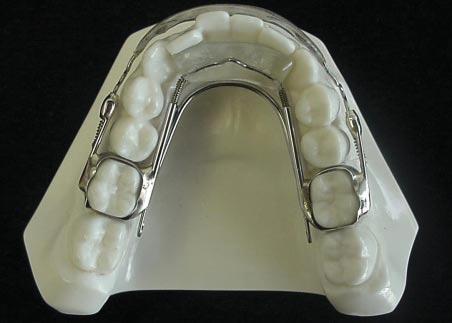 The appliance is designed to correct crowding, spacing, and rotations of the anterior teeth with force levels that can be adjusted to meet the requirements of each case. (Fig. 2).