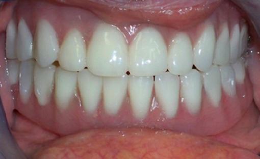 Fixed (Non-Removable) Hybrid Denture or Prosthesis Five Or
